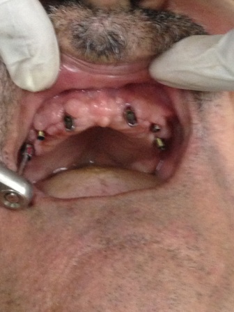 Implex Dental implants